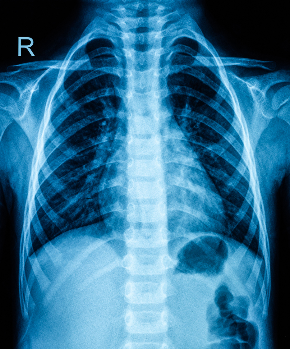 Un filtre en étain pour réduire la dose d'irradiation des scanners