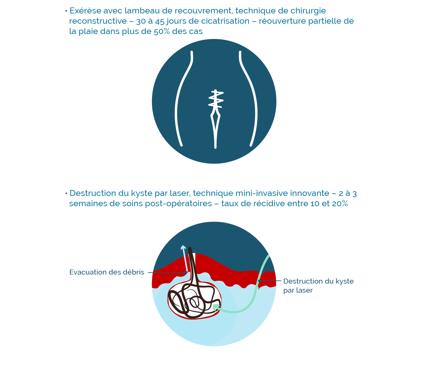 Le kyste pilonidal