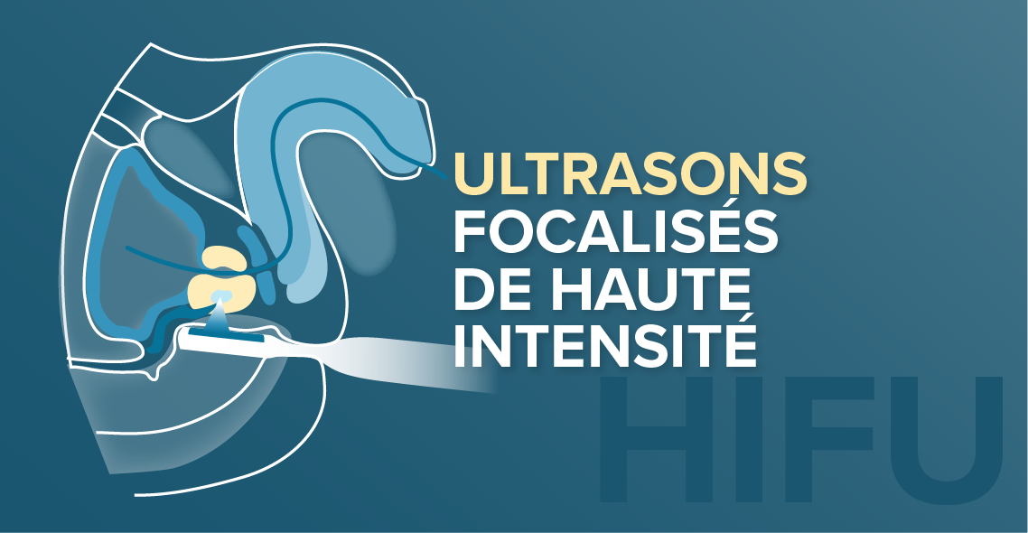 Des ultrasons (HIFU) pour traiter le cancer de la prostate