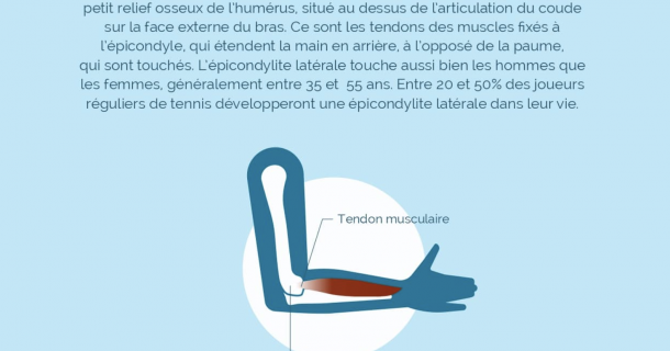 L’épicondylite latérale ou « tennis elbow »
